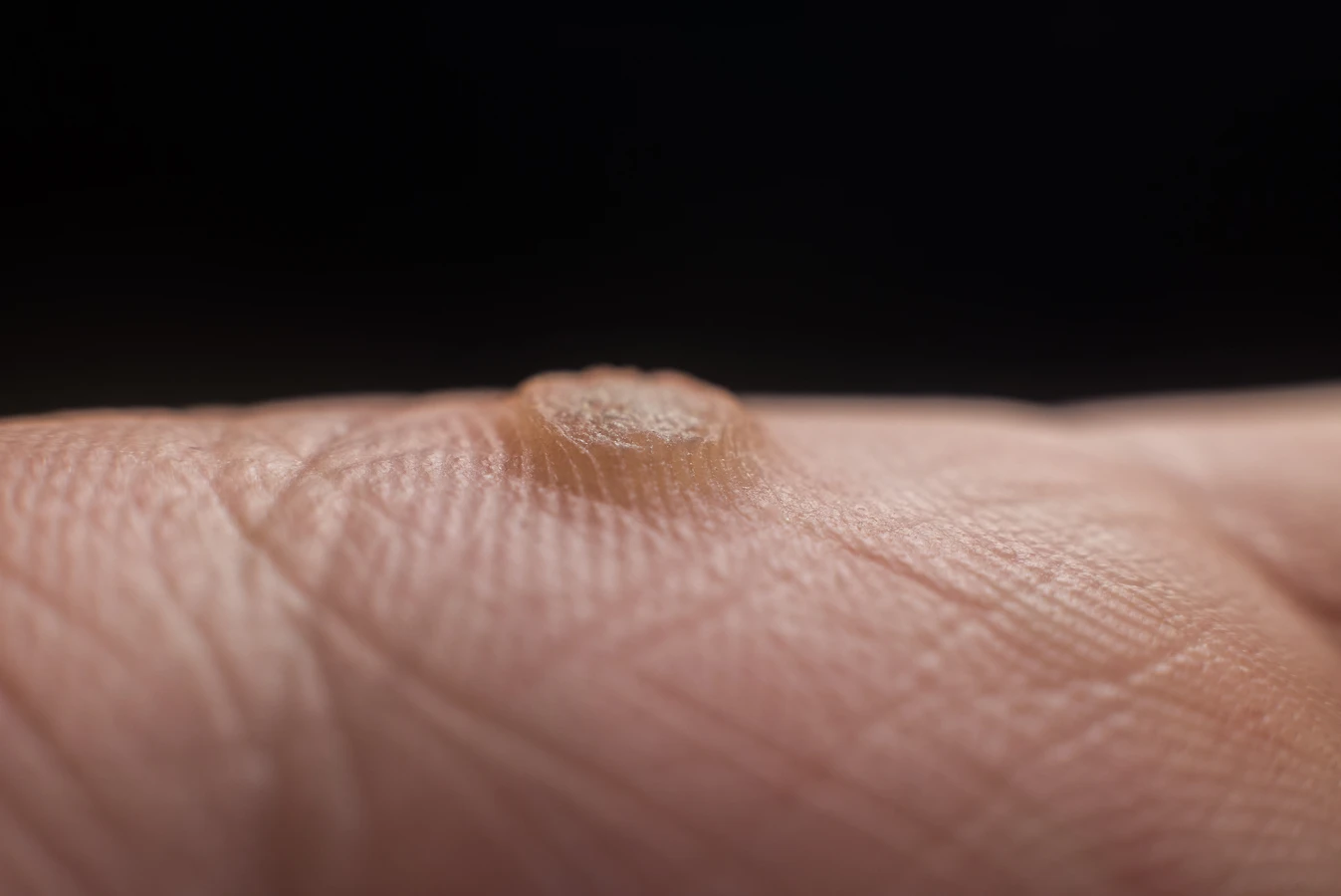 Co jest dobre na kurzajki dla dzieci?