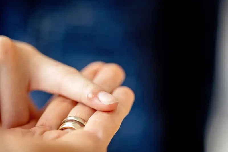 co-na-kurzajki-na-palcu-1