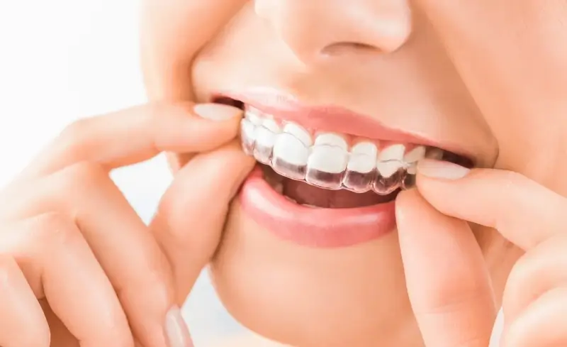 Jak długo trwa leczenie nakładkami Invisalign?