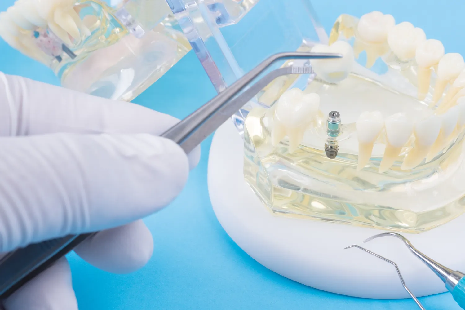 Czy leczenie kanałowe pod mikroskopem boli?